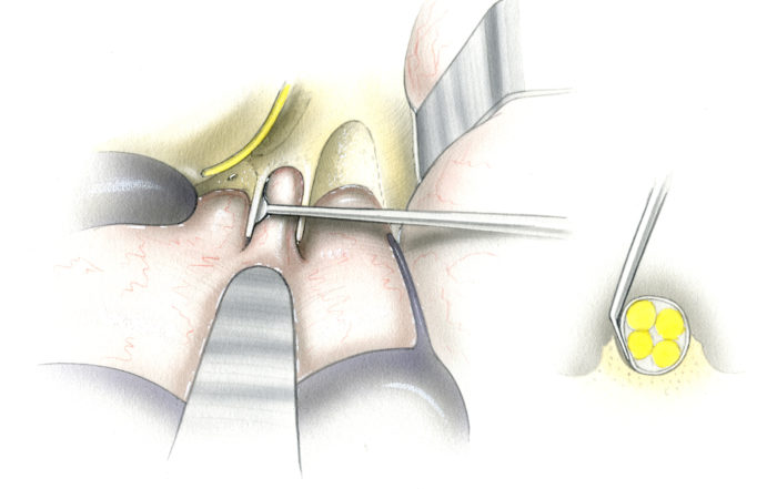 Translabyrinthine Approach Skull Base Surgery Atlas