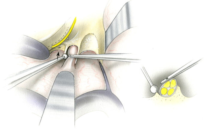 Translabyrinthine Approach Skull Base Surgery Atlas