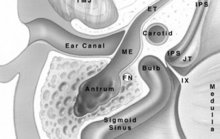 Axial view of the jugular foramen region. FN, facial nerve; IPS, interior petrosal sinus; ET, eustachian tube; JT, jugular tubercle; ME, middle ear; TMJ, temporomandibular joint; 9, glosspharyngeal nerve.)