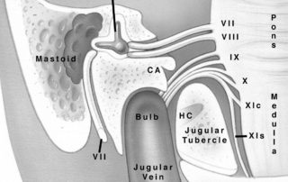 13. Coronal view of the jugular foramen region. (CA, cochlear aqueduct; HC, hypoglossal canal; 5, trigeminal nerve; 7, facial nerve; 8, audiovestibular nerve; 9, glossopharyngeal nerve; 10, vagus nerve; 11c, cranial root of the accessory nerve; 11s, spinal root of the accessory nerve.)