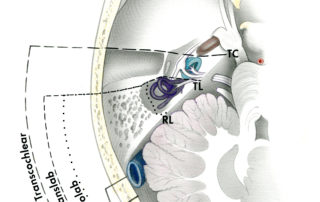 An axial view of the skull through the level of the of the internal auditory canal and cerebellopontine angle.
