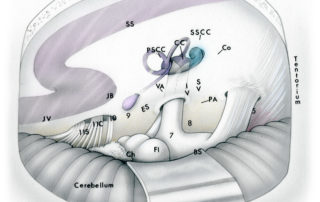 Anatomical relationships of the cerebellopontine as seen through a retrosigmoid posterior fossa craniotomy. JV -jugular vein, JB -jugular bulb, SS -sigmoid sinus, 11s -spinal component of the accessory nerve, 11c -cranial component of the accessory nerve, 10 -vagus nerve, 9 -glossopharyngeal nerve, Ch -choroid plexus emanating from the lateral recess fo the fourth ventricle, Fl -flocculus, BS -brainstem surface (pons), 7 -facial nerve, 8 -audiovestibular nerve, 5 -trigeminal nerve, PA -porus acousticus, IV -inferior vestibular nerve, SV -superior vestibular nerve, ES -endolymphatic sac, VA -vestibular aqueduct, PSCC -posterior semicircular canal, CC -common crus, SSCC -superior semicircular canal, Co -cochlea.