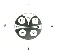 At the lateral extremity of the IAC the relationships of the superior vestibular (SV), inferior vestibular (IV), facial (7), and cochlear (C) nerves are highly predicatable. In this location, the canal is completely divided in the horizontal plane by the transverse crest (TC) and its upper compartment is partitioned by a vertical bony crest (VC) also known as Bill’s bar (After William F. House, MD). (A-anterior, P-posterior, S-superior, I-inferior)