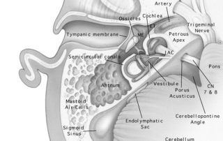 Axial view of temporal bone anatomy. (IAC, internal auditory canal; ME, middle ear; ET, eustachian tube; CN 7 & 8, facial and audiovestibular nerves.)