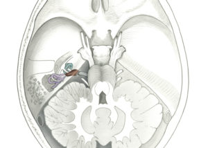 Intracanalicular acoustic neuroma seen in an axial section of the head at the level of the internal auditory canal.