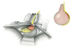 The last portion of an acoustic neuroma to be removed is typically the capsular peel which adhers to the facial nerve just outside of the porus acousticus.