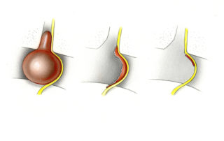 Tumor resection may be total, subtotal, or near total. Subtotal resection, in which a sizable portion of tumor is left, is seldom indicated. Near total removal, which leaves a thin capsular peel, is sometimes justified as a consession to neural integrity. The risk tumor recurrence following near total resection appears to be small.