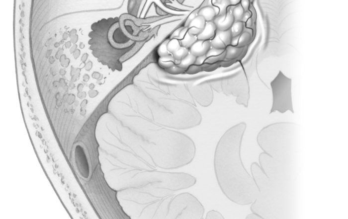 Anatomy of Tumors in Skull Base Surgery and Neurotology – Skull Base ...