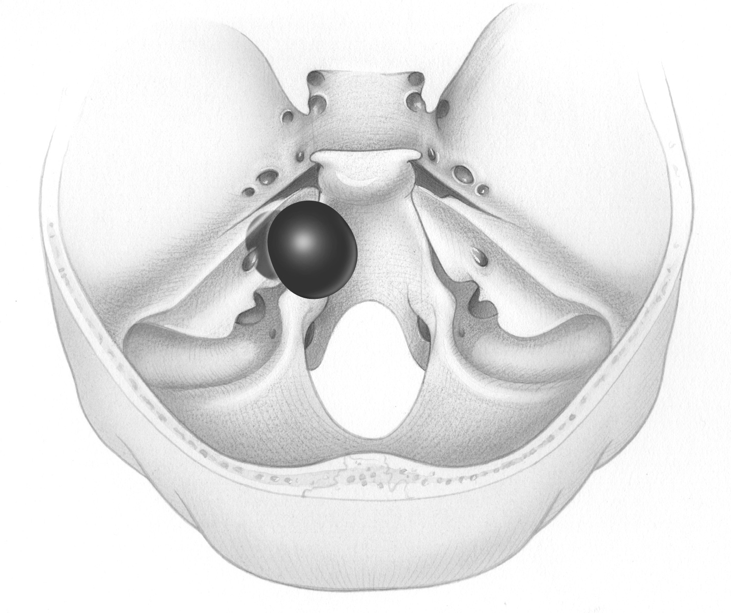 Anatomy Of Tumors In Skull Base Surgery And Neurotology Skull Base Surgery Atlas 