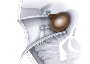 Axially oriented schematic view of a translabyrinthine posterior fossa craniotomy used in the exposure of a medium-sized acoustic neuroma. Note that bone has been removed 1 to 2 cm behind the sigmoid sinus which is retracted posteriorly. The amount of cerebellar retraction is considerably less than that required with the retrosigmoid approach. Note that the semicircular canals have been removed en route to exposing the internal auditory canal.