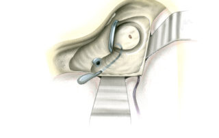 The labyrinthectomy is then deepened to open and then remove the superior semicircular canal. The subarcuate artery is often encountered coursing through the arch of this canal. At this stage the endolymphatic sac and duct are exposed. The duct wraps around the common crus (joins the non-ampullated ends of the superior and posterior canals) on its J-shaped route to the vestibule. (SA, subarcuate artery; ES, endolymphatic sac; CC, common crus.)