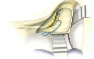 Following labyrinthectomy, the vestibule is opened widely. This exposes the ampullae of the superior and lateral canals which approximate each other anteriorly and the posterior ampulla which is tucked posteroinferiorly. In the floor of the vestibule lies the elliptical recess in which lies the utricle whose glistening white otoconial membrane is often visible. Wide opening of the vestibule usually requires drilling slightly under the facial nerve with a diamond burr. (ES, endolymphatic sac; PCA, posterior semicircular canal ampulla; FN, facial nerve; ER, eliptical recess for the utricle; LCA, lateral semicircular canal ampulla; SCA, Superior semicircular canal ampulla.)