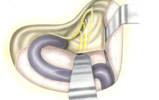 The internal auditory canal lies in the bone deep to the labyrinth as seen in this translucent illustration. The vestibular nerves originate in the vestibule at the ampullae and otolithic organs. The facial nerve is the only nerve which extends lateral to the vestibule from this surgical perspective. (JB, jugular bulb; GG, geniculate ganglion; LFN, labyrinthine segment of the facial nerve; SVN, superior vestibular nerve; IVN, inferior vestibular nerve.)