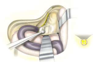 Exposure of the internal auditory canal commences with a cutting burr. Note that the canal courses posteriorly after taking its origin at the vestibule. The initial identification of the canal is performed in its mid-section and towards the porus acusticus. To avoid possible injury to the facial nerve in its labyrinthine segment, the lateral extremity of the canal is not dissected until a later stage.