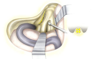 Once the plane of the internal auditory canal has been identified, troughs are drilled above and below the canal parallel to its long axis. Inferiorly, the deep lateral limit is the cochlear aqueduct. Once open, CSF may gush form its lumen, particularly in the tumors smaller than 3cm. The cochlear aqueduct serves as a marker for the neural compartment of the jugular foramen which lies medial to the jugular bulb. If additional inferior exposure is desired, it is possible to skeletonize the dural envelope overlying the ninth nerve. Superiorly, it is important not to carry the trough too laterally as this jeopardizes premature exposure (and possible injury) to the facial nerve in its labyrinthine segment. (CA, cochlear aqueduct.)