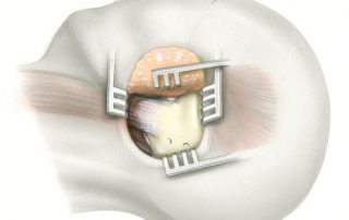 The translabyrinthine approach commences with an incision approximately 4 cm behind the postauricular sulcus. The incision is carried directly down to bone, thus traversing the posterior portion of the temporalis muscle. Leaving the muscle attached to subcutaneous tissue and periosteum affords a more robust closure. A wide exposure of the mastoid is required as well as access to the anterior portion of the occipital bone lying behind the sigmoid sinus. During flap elevation emissary veins are often divided. These can be readily controlled with bone wax.