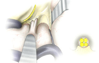 The final maneuver which complete internal auditory canal exposure is excavation of the fundus. The transverse crest is a prominent bony landmark which separates the superior from the inferior vestibular nerves. When the distal canal is deeply invaded, exposure may be continued along the superior and inferior vestibular nerves into the vestibule. The goal of internal auditory canal exposure is two have exposed approximately two thirds of the circumference of the internal auditory canal. This primary reason for this degree of excavation is to permit the unhindered insertion of right angled microinstruments (an arachnoid knife or hook) needed to gently establish the plane between the tumor and facial nerve. Once exposure of the internal auditory canal is complete, it is complete accessible to surgeon for microdissection. It is particularly important to widely funnel the porus acusticus. Ledges left at the porus may obscure the tumor and facial nerve dissection plane as it acutely angulates at the exit of the canal. (TC, transverse crest; IVN, inferior vestibular nerve; SVN, superior vestibular nerve.)