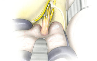 The relationships at the distal end of the internal auditory canal have been made transparent. The superior vestibular nerve terminates at the ampullae of the superior and lateral canals. The inferior vestibular nerve terminates at the ampulla of the posterior semicircular canal. Note its branch with passes inferiorly towards the saccule. The facial nerve is the only nerve which continues lateral to the vestibule, and it becomes gradually more superficial as it does so. A vertical crest of bone, often referred to a Bill’s bar (after William F. House, MD), hangs in the vertical plane between the superior vestibular nerve and the facial nerve. As a landmark, it is more easily felt with a hook than seen. While many surgeons use it as a landmark for identification of the facial nerve, this author prefers to expose the facial nerve at its entry into fallopian canal rather than relying upon this subtle bony spur.