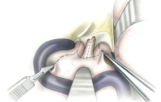 Following bipolar cautery of the dura, it is incised with the tip of a No. 11 blade. Once a small opening has been created, a blunt dissection (e.g. Rhoton No. 4) is inserted to gently elevate the dura from the cerebellar surface. Stout scissors are then used to open the remainder of the incision line. Incision is usually much easier for the superior limb of the incision, where the dura is relatively thin, than it is inferiorly where the endolymphatic sac considerably augments dural thickness.