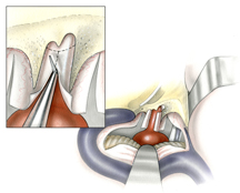 The internal auditory canal dura is then opened with up-biting and angled scissors. The internal auditory canal and cerebellopontine angle incisions are than connected at the level of the porus acusticus. The cerebellar hemisphere may than be elevated for the tumor surface, thus exposing its cerebellopontine angle component. If CSF has yet to be liberated, the cisterna magna should be entered at this point by dissecting between the lower pole of the tumor and the nerves of the jugular foramen.