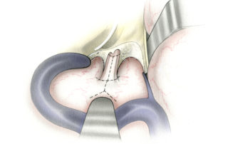 In small tumors, the size of the of the dural opening may be tailored to meet the needs of the tumor at hand. In the case of a small cerebellopontine angle component, a simple Y may be sufficient. Such a limited incision may often be partially or completely suture closed following tumor resection.