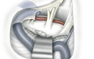 Extended translabyrinthine approach which involves removal of bone above and below the internal auditory canal deeply into the petrous apex and lateral aspect of the clivus. This permits a somewhat improved view anteriorly into the pre-pontine cistern. Note that the ipsilateral sixth nerve and basilar artery are visible.
