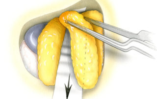 Strips fat are then laid, one after the other, into the craniotomy defect both to obliterate the dead space and to discourage CSF leakage. A retractor is used to displace the previously placed fat posteriorly in order to open up a passage for subsequent strips. The intention of fat packing is to obliterate the craniotomy defect, not to fill the intracranial cavity left behind following tumor resection. (A) axial view.