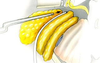 Strips fat are then laid, one after the other, into the craniotomy defect both to obliterate the dead space and to discourage CSF leakage. A retractor is used to displace the previously placed fat posteriorly in order to open up a passage for subsequent strips. The intention of fat packing is to obliterate the craniotomy defect, not to fill the intracranial cavity left behind following tumor resection. (B) Surgical view.