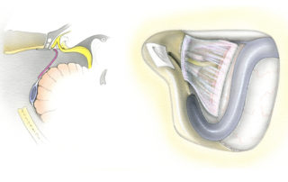 An option while closing a translabyrinthine craniotomy is to cover the dural defect with a fascial graft. This helps to both re-establish the dura and restrain the fat graft from prolapsing into the cerebellopontine angle. In addition, the posterior fossa opening can often be narrowed somewhat, but not completely eliminated, through suture closure of the dura incision.