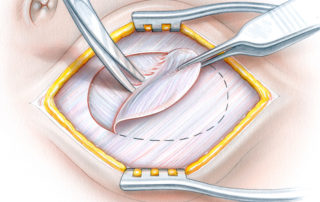 In harvesting fascia for the anterior abdominal wall, it is important to avoid creating a defect which is at high risk of leading to a ventral hernia. Usually, the thick rectus fascia and be split with its lateral layer used as a graft. Alternatively, an oval shaped full thickness graft can be taken with the defect closed primarily with stout sutures.