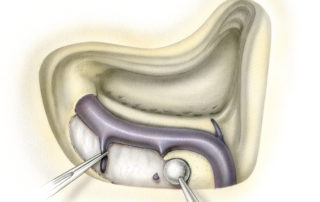 Following skeletonization of the sigmoid sinus with a cutting burr, its bony covering is removed with a large diamond burr. In addition, the retrosigmoid dura is exposed for 1 to 2 cm behind the sinus. Larger burrs (preferably 8 to 10 mm in diameter) are favored as they present a broad flat working surface and are less likely to lacerate the dura or vein wall. During retrosigmoid exposure it is often necessary to control one or more emissary veins with either bipolar cautery or surgicel packing. While the sigmoid sinus and dura usually can be completely freed of their bony covering, it is reasonable to leave a few small flakes of bone attached as long as they do not restrict sigmoid or dural mobility and are not sharp edged.