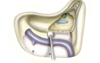 Once the sigmoid has been decompressed, the antrum is opened. Exposure should be carried anteriorly until the entire length of the lateral semicircular canal is visible. This reveals the short process of the incus. Excessive opening of the epitympanum should be avoided as this widens the connection between the craniotomy and the middle ear, a circumstance which increases the risk of CSF otorhinorrhea. At this stage the posterior fossa dura between the sigmoid sinus and labyrinth is uncovered and tegmen mastoideum and tympani are removed. Removing this bone plate from the middle fossa floor is optional in smaller tumors, but is important in larger tumors where maximal cerebellopontine angle exposure is desired. Removal of the bony edge along the superior petrosal sinus, where the posterior and middle fossae dura meet, is often more technically challenging than in other areas. This elongated bony wedge can usually be dissected free as a piece using dura elevators and sharp dissection as needed. Hemorrhage from the inferior petrosal sinus can usually be easily controlled with either bipolar cautery or packing.