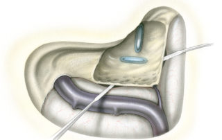 Once the posterior and middle fossa dural faces have been exposed to the level of the labyrinth, elevation of the dura from the surface of the petrous bone is performed.