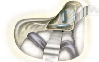 Dural elevation permits insertion of retractors which substantially augment the exposure of deeper structures by providing a wider field of action. The retractor also serves to protect the sigmoid sinus from inadvertent injury, particularly from the rotating shaft of the drill. In this illustration the semicircular canals and facial nerve have been made visible to demonstrate the relationship between these two structures. Note that the facial nerve parallels the inferior aspect of the lateral semicircular canal throughout its course and is closely related to only the inferior most portion of the posterior semicircular canal. Knowledge of these highly consistent relationships helps the surgeon to perform the labyrinthectomy rapidly and with safety. (VFN, vertical or mastoid segment of the facial nerve; 2G, second genu of the facial nerve; HFN, horizontal or tympanic segment of the facial nerve; O, ossicles in the epitympanum; SSCC, superior semicircular canal; PSCC, posterior semicircular canal; LSCC, lateral semicircular canal.)