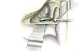 Removal of the semicircular canals is commenced in the sinodural angle. As the labyrinth is exceptionally hard bone there is a tendency for the drill to run, particularly when working with the tip of the burr. By creating deep troughs parallel to the middle and posterior fossa dural surfaces, it is possible to work with the side of the burr in a controlled manner when approaching the facial nerve.
