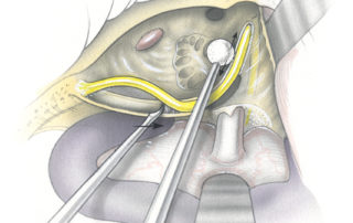 A diamond burr is them used to skeletonize the FN from the stylomastoid foramen to the geniculate ganglion. Elevation of the FN from its bony channel proceeds from inferior to superior. Bleeding of the sytlomastoid artery is common. This is usually best managed by gentle pressure rather than cautery.The chorda tympani nerve is transected sharply.