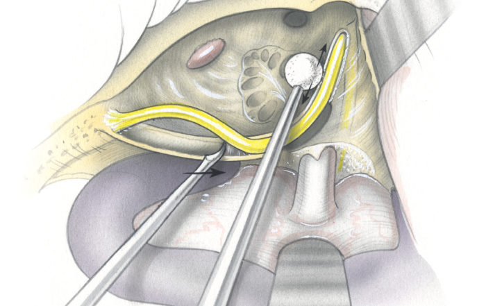 Transcochlear approach – Skull Base Surgery Atlas