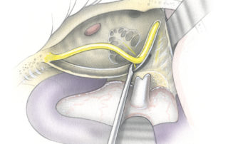 Elevation of the tympanic segment requires transection of the nerve to the stapedius muscle.