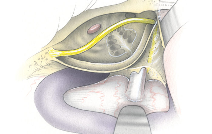Transcochlear approach – Skull Base Surgery Atlas