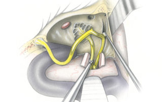 The dura of the internal auditory canal is then opened and the eighth nerve (cochlear and both vestibular branches) are then transected. The facial nerve is then out the proximal fallopian canal with a round knife.