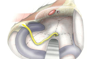 The anterior limits of bone removal superficially are the genu of the carotid artery and the orifice of the eustachian tube. The deep limit is the point at which the dura-bone interface “straightens” indicating that the posterior face of the clivus in the midline has been reached. The marrow space of the apical petrous bone and clivus often bleeds prodigiously during these later stages of the bone removal. Copious use of bone wax and surgicel usually controls this hemorrhage. Dural incision superficially is like that of the translabyrinthine approach: paralleling the superior petrosal sinus superiorly, following the sigmoid sweep over the jugular bulb inferiorly, and connecting across the porus acusticus. Medial to the porus, a Y-shaped incision opens the dura overly the apical petrous bone. (CA, carotid artery; ET, eustachian tube; CL, clivus.)