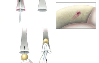 Closure of the eustachian tube in a manner which is watertight to withstand cerebrospinal fluid pressure is necessary with the transcochlear approach, as it is with many cranial base procedures. In preparation of eustachian tube occlusion, the orifice of the tube is widely drilled opened and the mucosa is stripped out from the infundibulum.