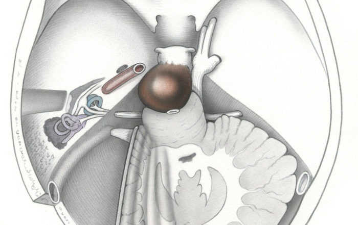 Transcochlear approach – Skull Base Surgery Atlas
