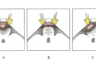 Characteristics of tumors ventral to the brainstem which affect the choice of operative approach. (A,B) Tumors confined to the mid-line are best managed with a presigmoid transpetrosal approach to minimize the need for cerebellar and brainstem retraction. The amount of petrosectomy performed depends, in part, upon the thickness of the tumor ventral to the brainstem. As a general rule, more bulky tumors which push the brainstem posteriorly require a lesser degree of petrosectomy in order to expose the tumor-brainstem interface. (C) Tumors with a substantial lateral component may open a pathway adjacent to the displaced pons, thus allowing a conventional retrosigmoid approach without need for supplemental petrosectomy. A pre-sigmoid opening may still be needed when the tumor extends beyond the midline to the side opposite of the main tumor mass.