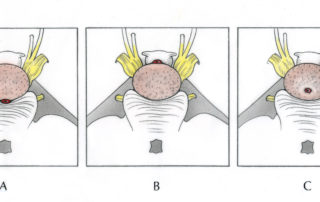 Possible relationships of the basilar artery to a prepontine tumor. The vessel may be situated in one of three positions: Posterior to the tumor on the surface of the pons (most common location; A), anterior to the tumor elevated from the pontine surface (B), and enveloped by the tumor (C). In the later two situations radical tumor removal carries a substantial risk of brainstem ischemia due to interruption of the pontine perforating vessels.