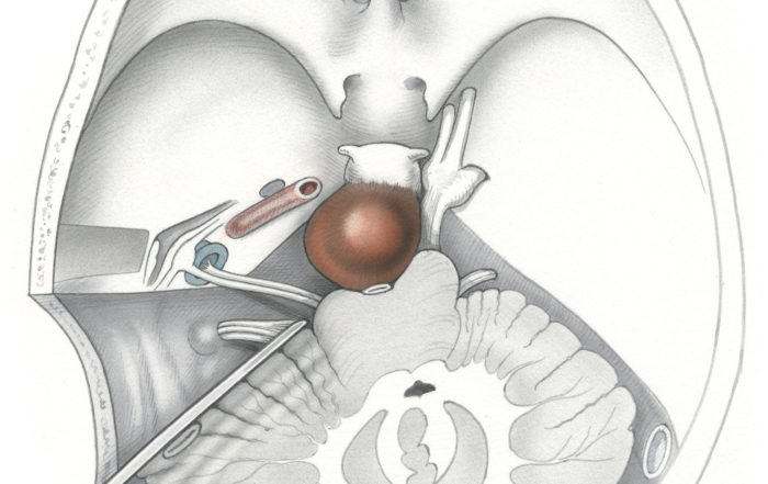 Transcochlear approach – Skull Base Surgery Atlas