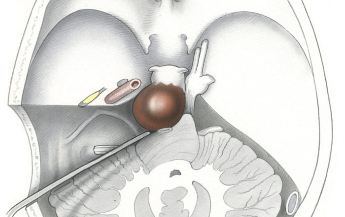 Transcochlear approach – Skull Base Surgery Atlas