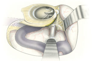 For the purposes of this book the transcochlear approach will be illustrated as an extension of the translabyrinthine approach although in actual practice labyrinthectomy and exposure of the IAC may take place after removal of the ear canal. In this initial view, a translabyrinthine craniotomy has been completed and the ear canal and middle ear are in view.