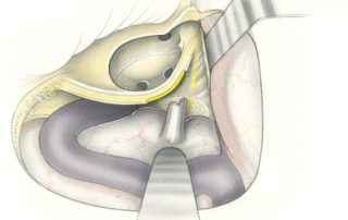 In the transcochlear approach it ear canal is ligated closed (see chapter on ear canal closure) and the ear canal, tympanic membrane, and ossicles are removed. (TP, tympanic plexus; RW, round window; OW, oval window; ET, eustachian tube; GG, geniculate ganglion.)