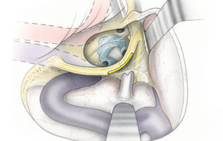 In this transparent view through the medial wall of the middle ear the relationships of the cochlear to the intrapetrous carotid artery and eustachian tube are revealed. Note that the cochlear nerve originates from the modiolus of the cochlea and then passes deep to the inferior vestibular nerve in the internal auditory canal. (JB, jugular bulb; CA, carotid artery; C, cochlea; ET,eustachian tube; TTM, tensor tympani muscle.)